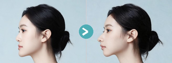 二次下颌轮廓手术