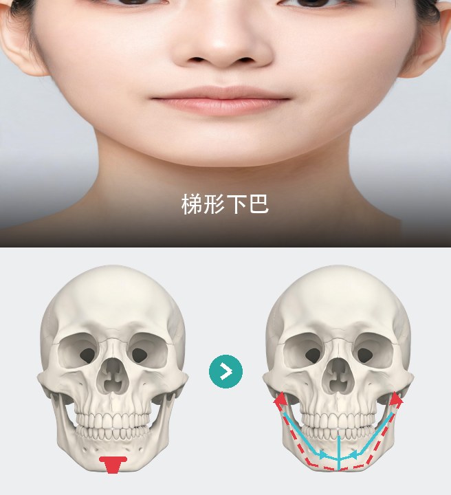 梯形下巴