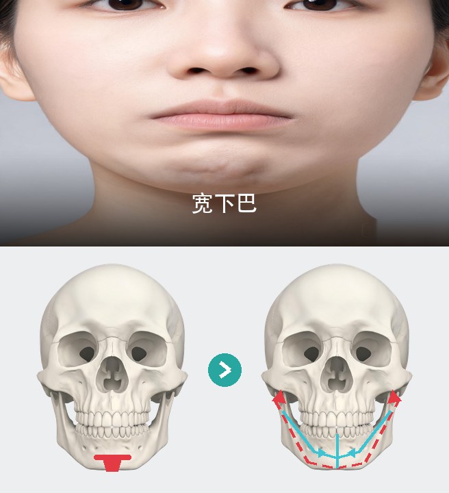 宽下巴
