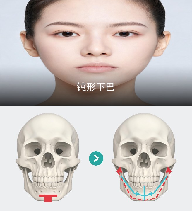 钝形下巴