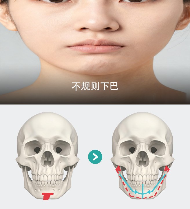 不规则下巴