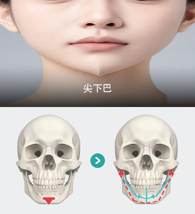 尖下巴