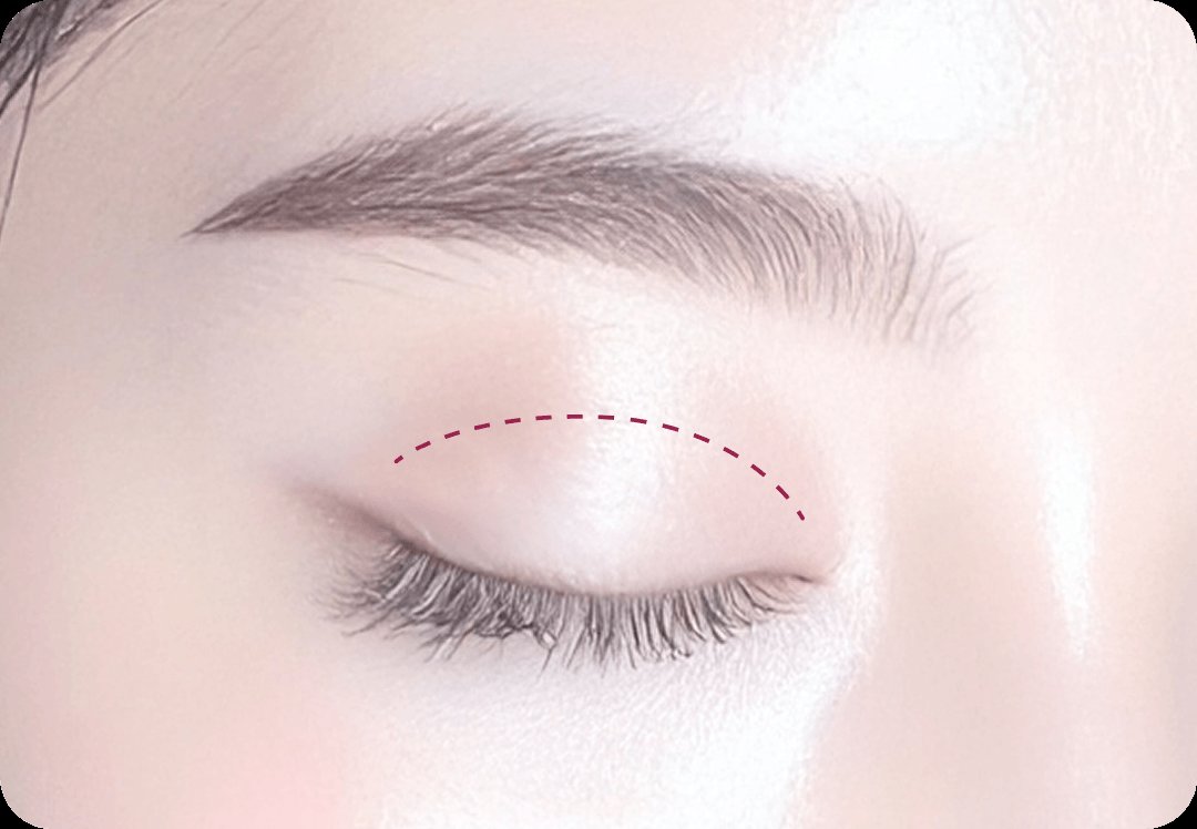 凡是与美 - Middle-Age 上睑下垂矫正术 - 非切开眼型矫正