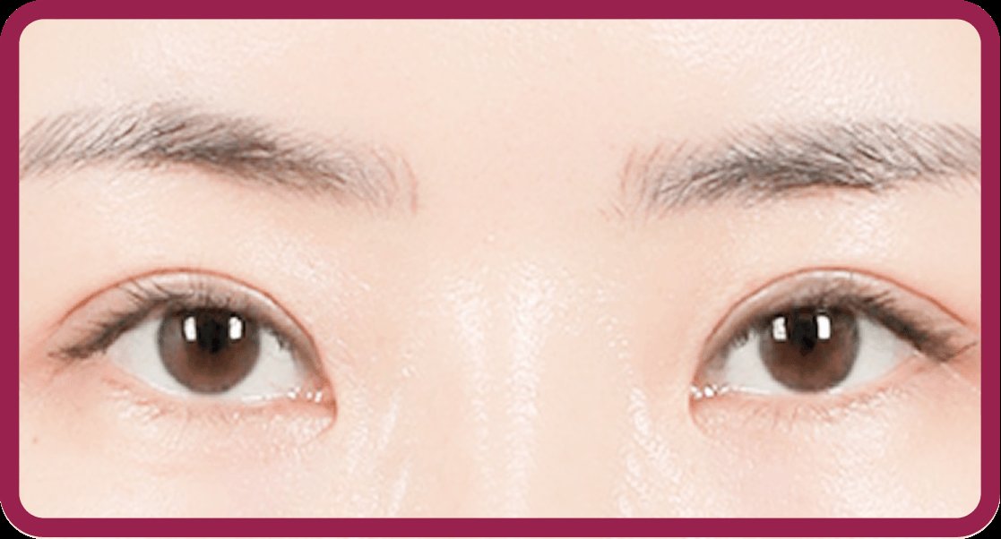 凡是与美 - Middle-Age 上睑下垂矫正术 - 控制眼型矫正术后1个月