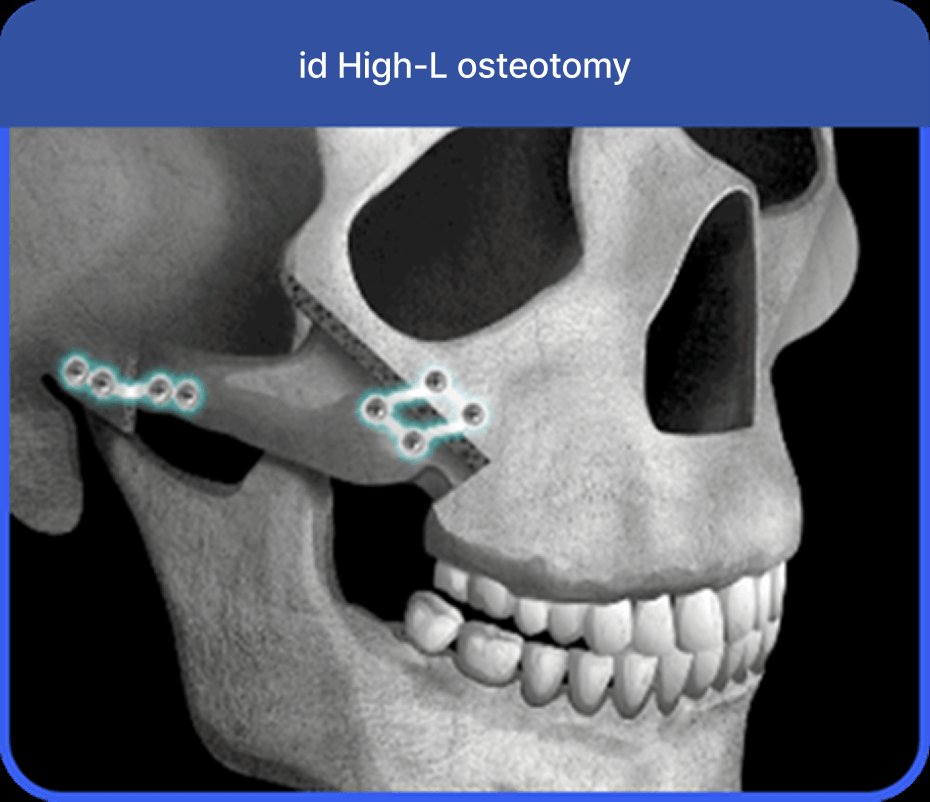 凡是与美 - 男性 面部轮廓 - 凡是与美 High-L Osteotomy