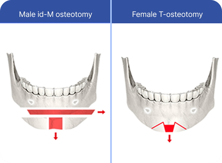 凡是与美 - 男性 面部轮廓 - 凡是与美-M Osteotomy Method