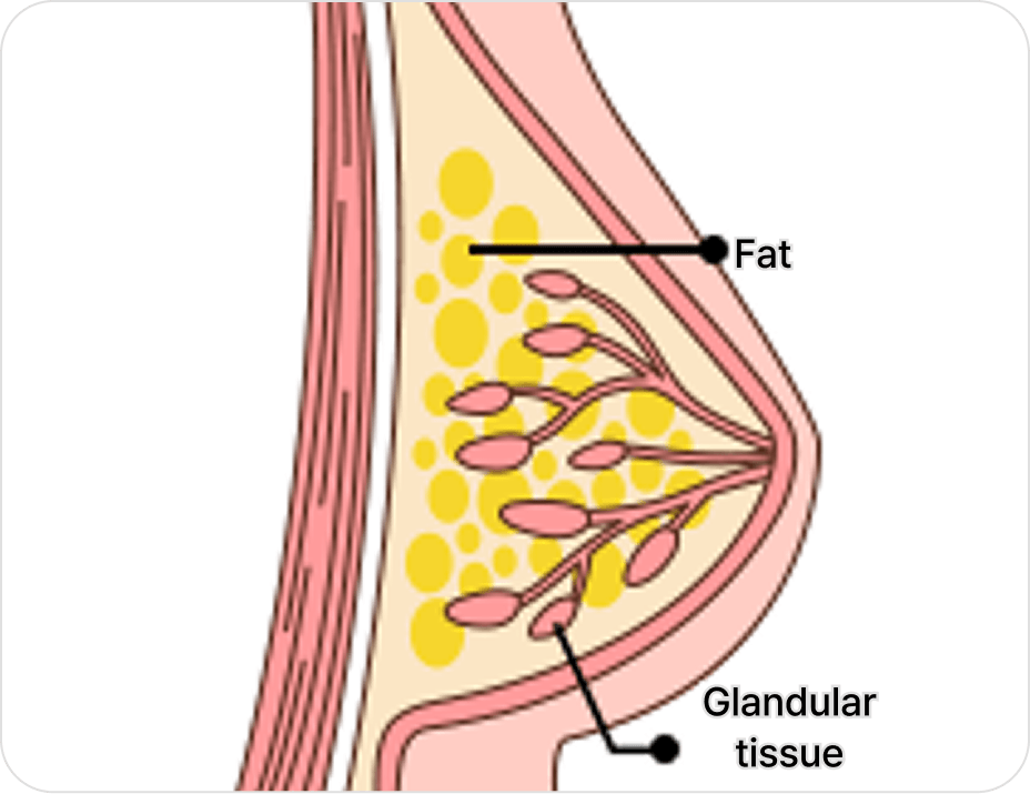 凡是与美 - 男性乳房发育矫正术 - 混合型