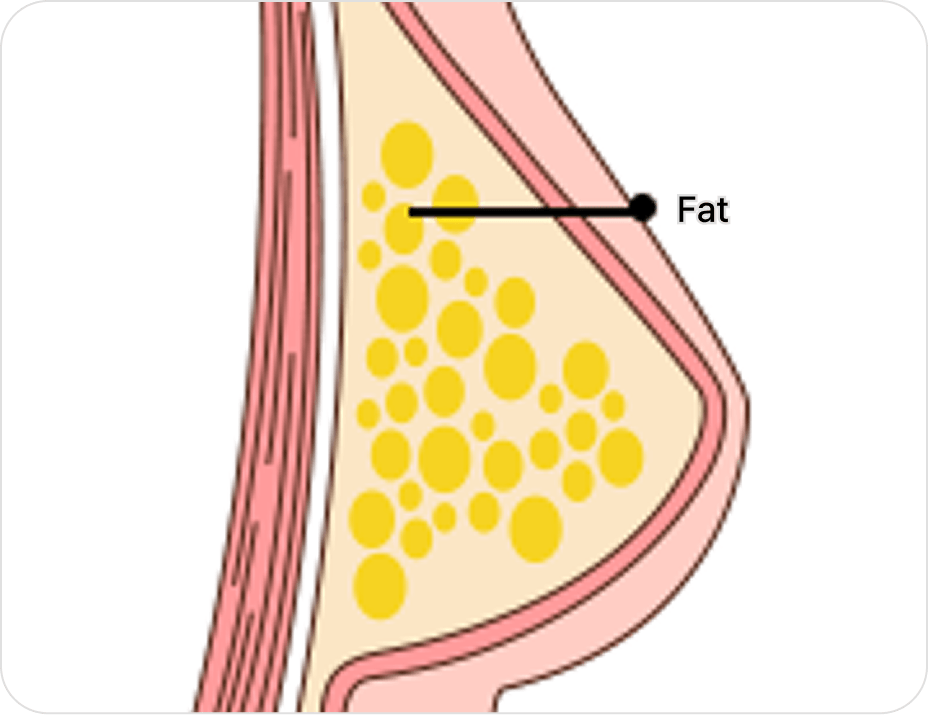 凡是与美 - 男性乳房发育矫正术 - 吸脂型