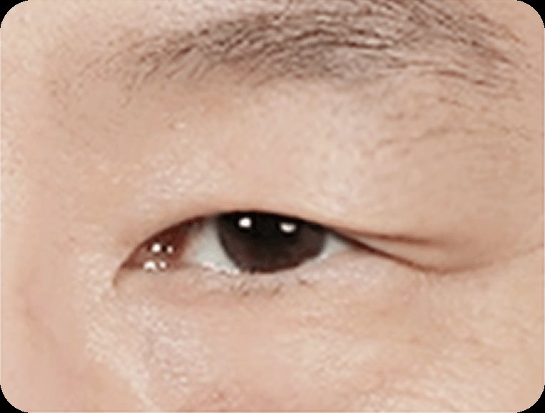 凡是与美 - 男性 Mid-Age 眼部手术 - 上眼睑整形 STEP 1