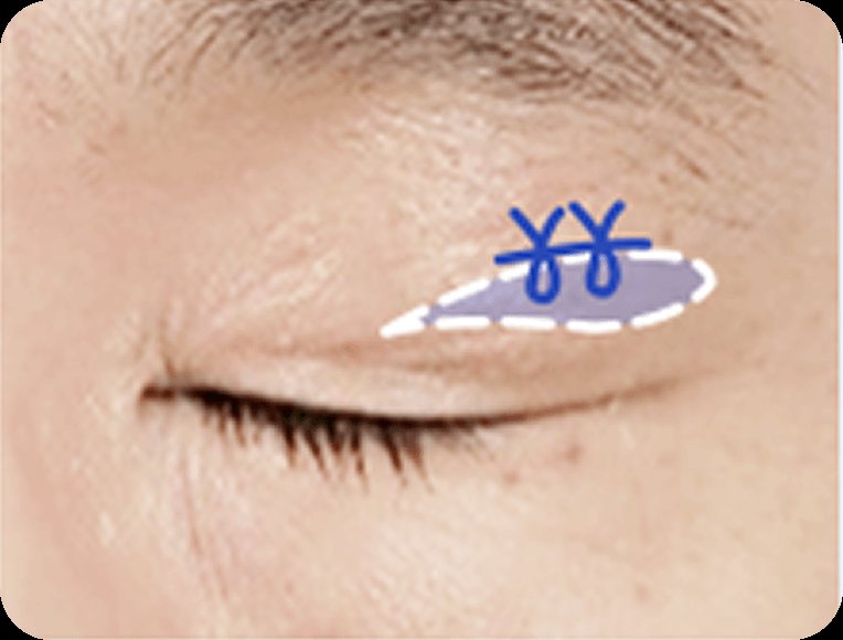 凡是与美 - 男性 Mid-Age 眼部手术 - 上眼睑整形 STEP 2