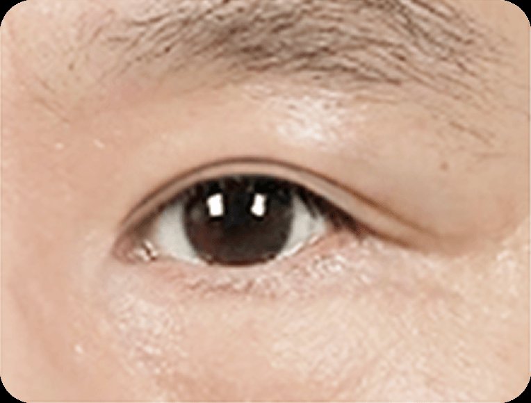 凡是与美 - 男性 Mid-Age 眼部手术 - 上眼睑整形 STEP 3