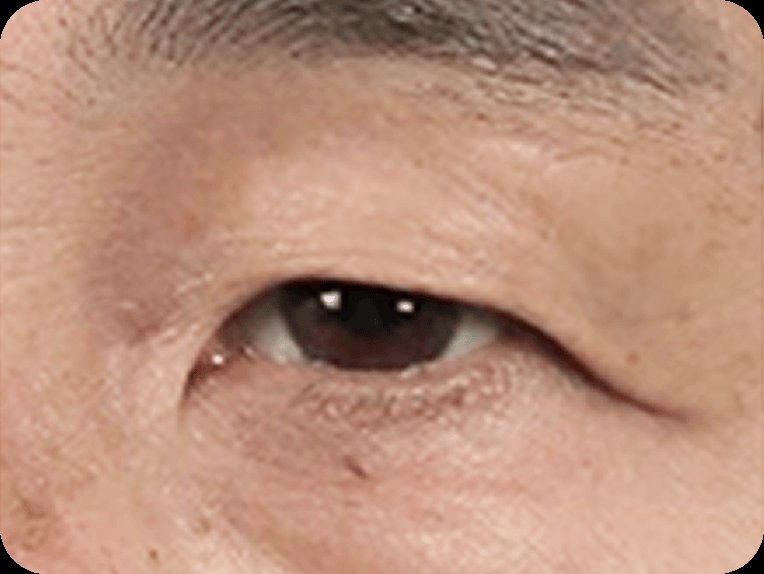 凡是与美 - 男性 Mid-Age 眼部手术 - 额部提升第1步