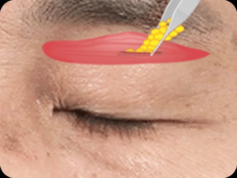 凡是与美 - 男性 Mid-Age 眼部手术 - 额部提升第2步