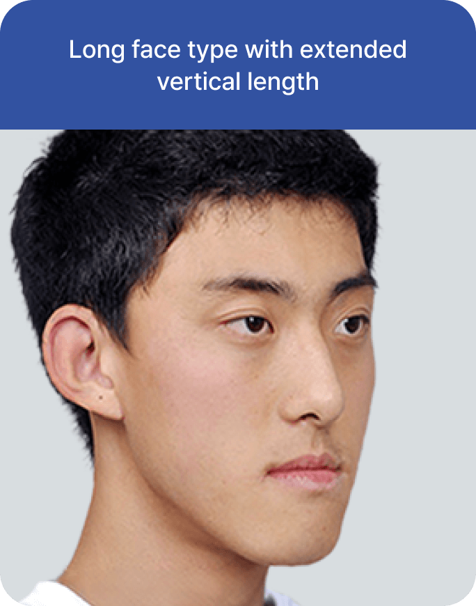 凡是与美 - 男性双鄂手术 - Candidate 类型 2