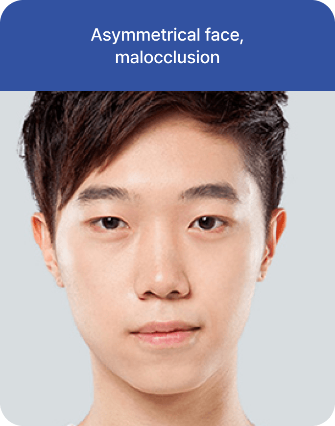 凡是与美 - 男性双鄂手术 - Candidate 类型 3