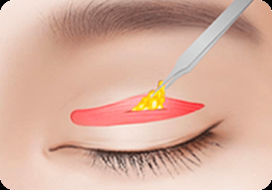 凡是与美 - 男性上睑下垂矫正术 - 切开双眼皮第2步