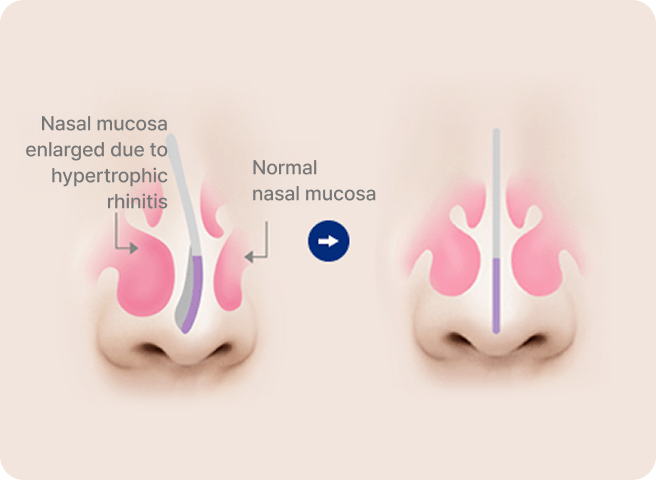 凡是与美 - 男性鼻部整形 - 肥厚性鼻炎