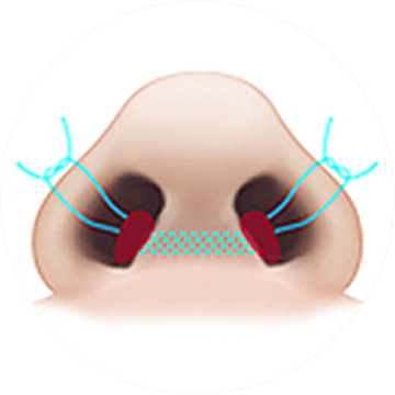 凡是与美 - 鼻翼缩小术 - Nostril Suturing 术前