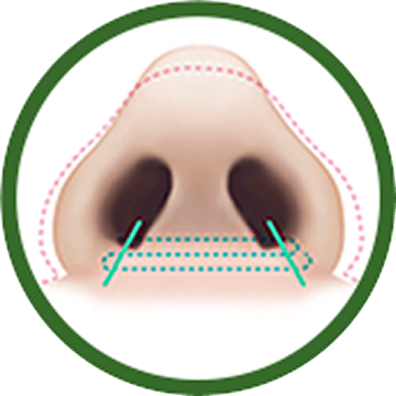凡是与美 - 鼻翼缩小术 - Nostril Suturing 术后