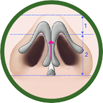 凡是与美 - 鼻翼缩小术 - Alar Shaping 术后