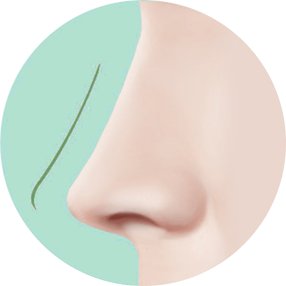 凡是与美 - Asian Rhinoplasty - 手术技术第1步