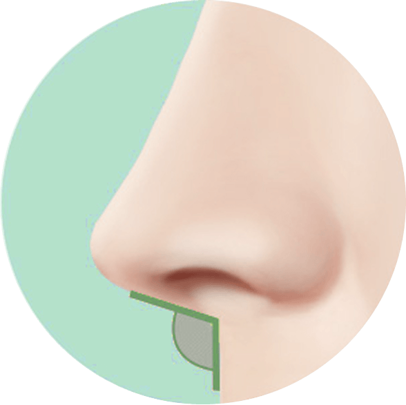 凡是与美 - Asian Rhinoplasty - 手术技术第2步