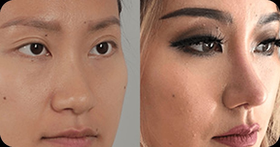 凡是与美 - Asian Rhinoplasty - 亚洲鼻三阶段延长