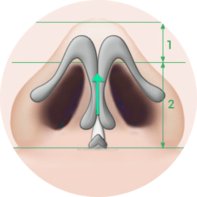 凡是与美 - Asian Rhinoplasty - 凡是与美 鼻部 Tip Shaving Technique