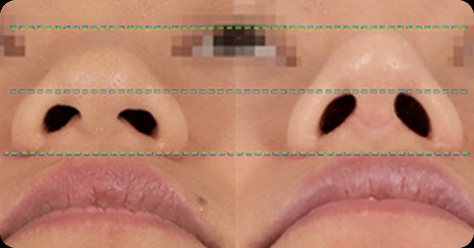 凡是与美 - Asian Rhinoplasty - 凡是与美 Tip Shaving for Asian 鼻部 Shape