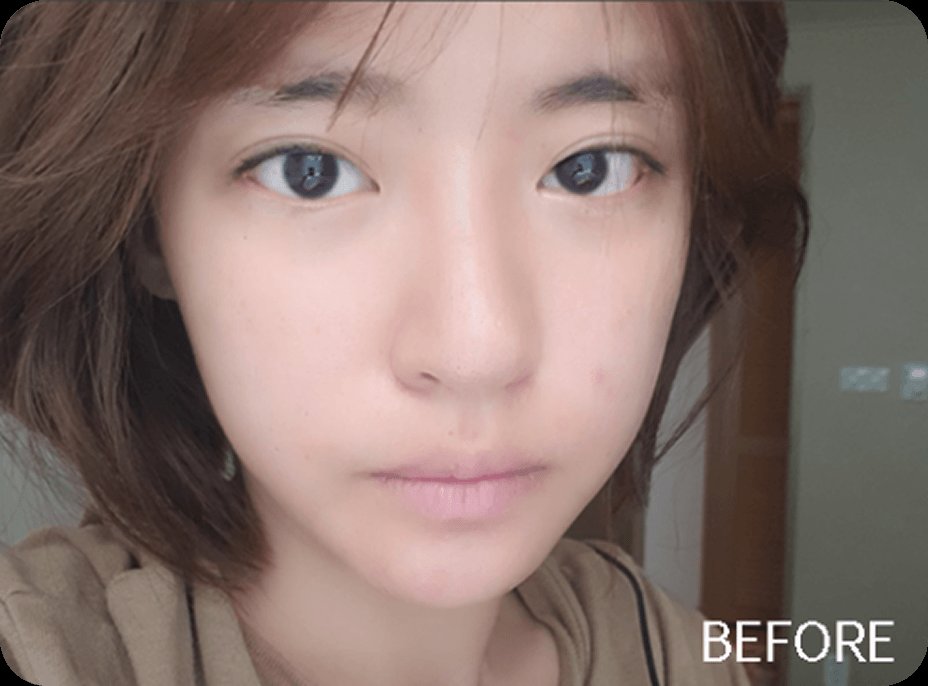 凡是与美 - Asian Rhinoplasty - Recovery Diary 术前