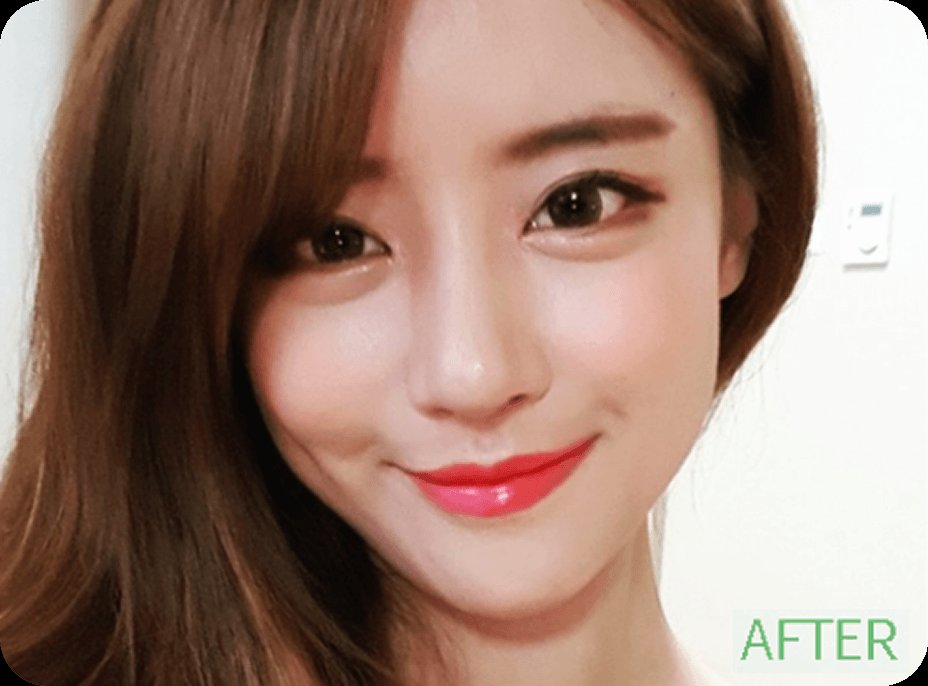 凡是与美 - Asian Rhinoplasty - Recovery Diary 术后