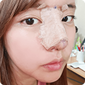 凡是与美 - Asian Rhinoplasty - 手术当日 术前