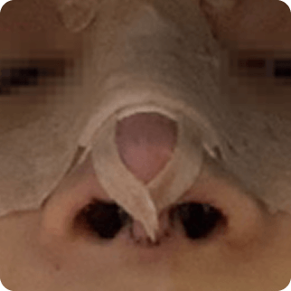 凡是与美 - Asian Rhinoplasty - 手术当日 术后