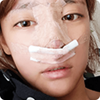 凡是与美 - Asian Rhinoplasty - Treatment after 2~3天 术前