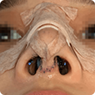 凡是与美 - Asian Rhinoplasty - Treatment after 2~3天 术后