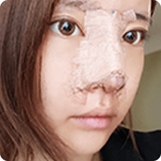 凡是与美 - Asian Rhinoplasty - 术后7天治疗前