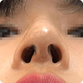 凡是与美 - Asian Rhinoplasty - 术后7天治疗后