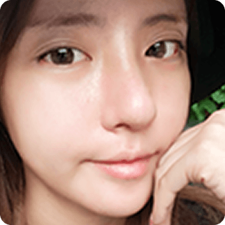 凡是与美 - Asian Rhinoplasty - 术后 7 days 术前