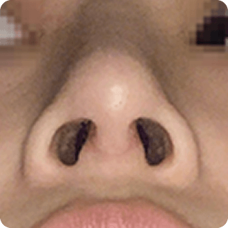 凡是与美 - Asian Rhinoplasty - 术后 7 days 术后