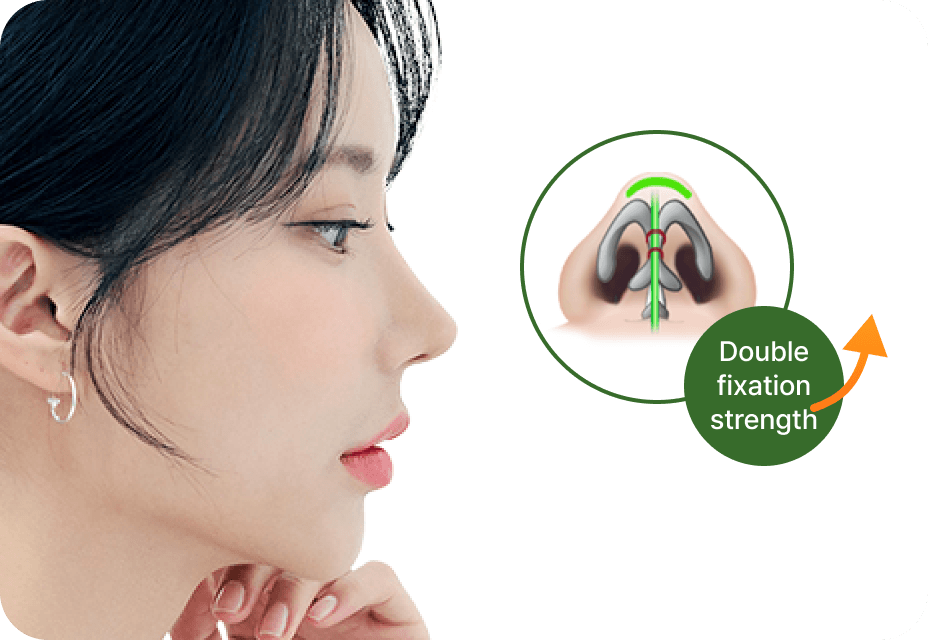 凡是与美 - No-Implant 鼻部 - 凡是与美 Double Wing Binding Technique
