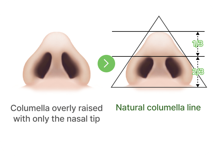 凡是与美 - Rhinoplasty - 自然线条鼻小柱