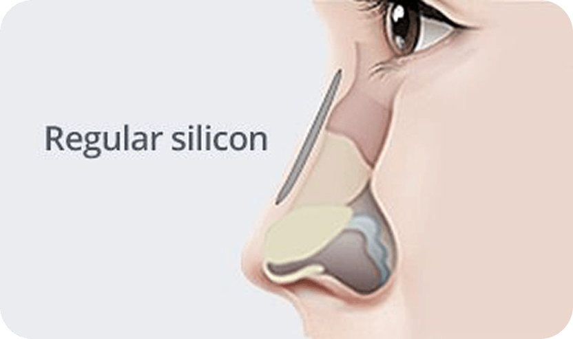 凡是与美 - Rhinoplasty - 常规硅胶鼻部手术