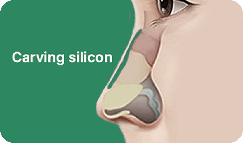 凡是与美 - Rhinoplasty - 雕刻硅胶鼻部手术