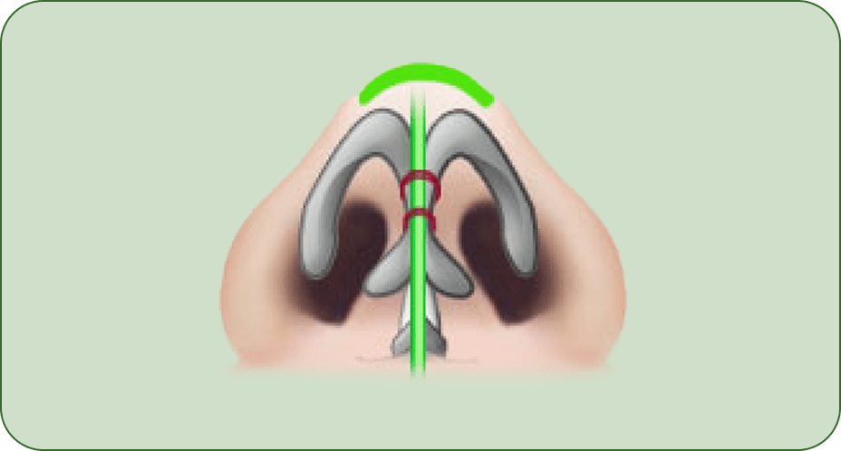 凡是与美 - Rhinoplasty - 芭比线条第1步