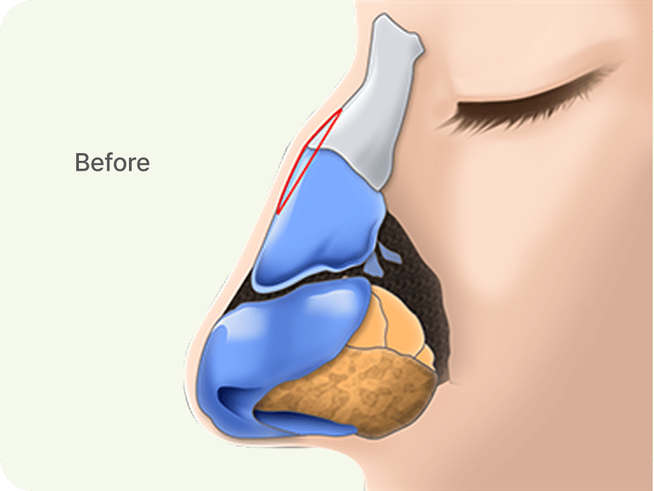 凡是与美 - Rhinoplasty - 鼻部 with a Small Hump 术前