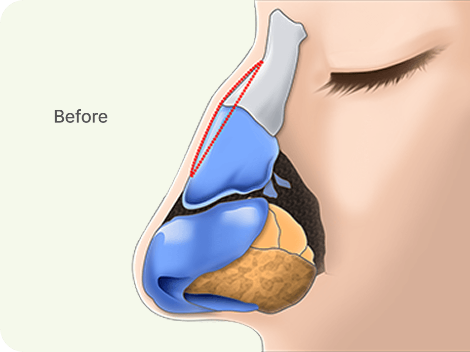 凡是与美 - Rhinoplasty - 鼻部 with a Large Hump 术前