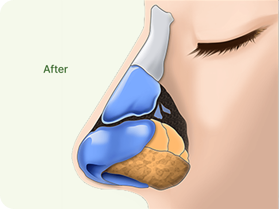 凡是与美 - Rhinoplasty - 鼻部 with a Large Hump 术后