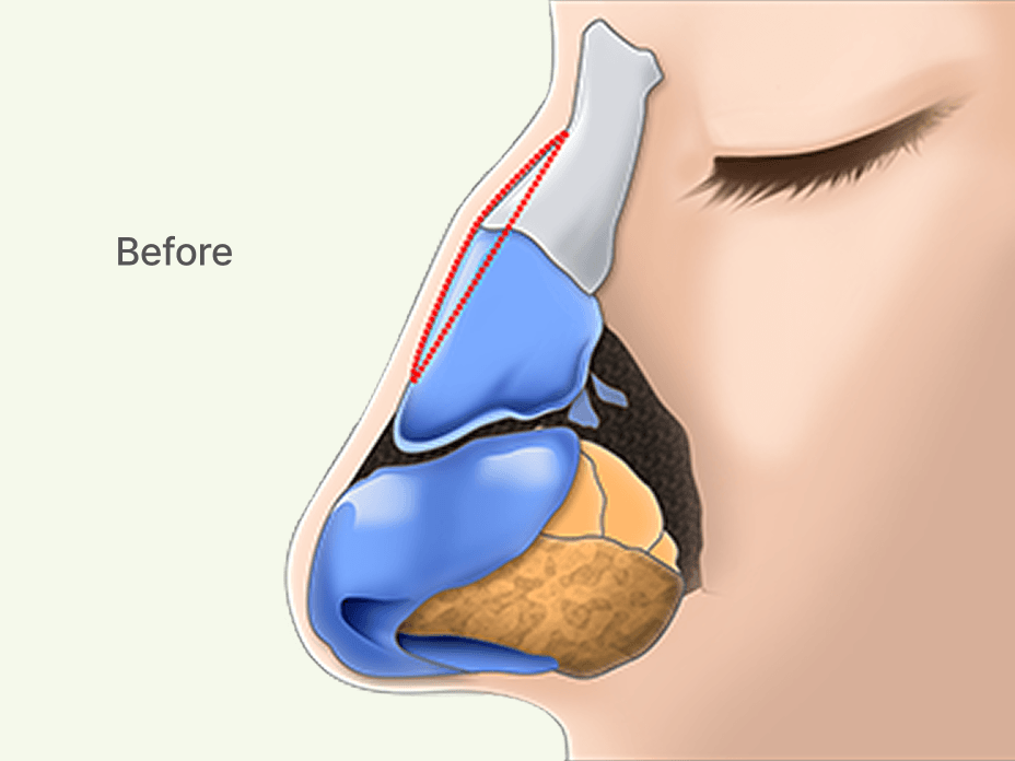 凡是与美 - Rhinoplasty - 驼峰且鼻梁歪斜术前