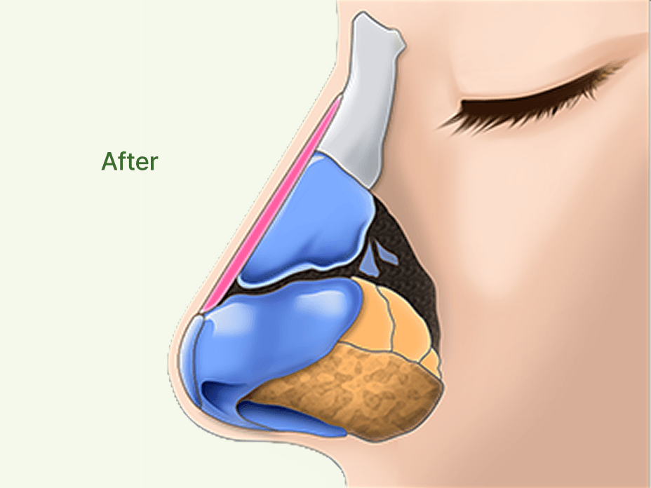 凡是与美 - Rhinoplasty - 驼峰且鼻梁歪斜术后
