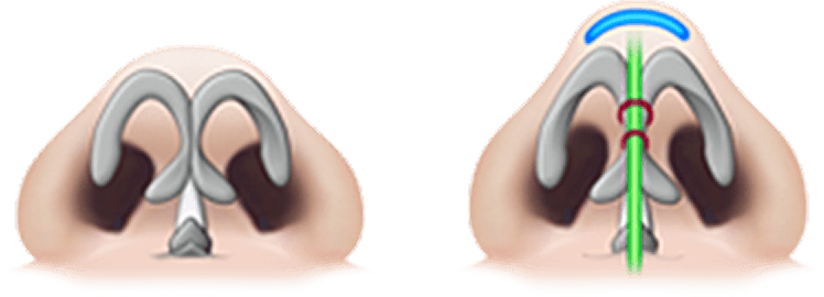 凡是与美 - Rhinoplasty - 鼻尖不塌陷
